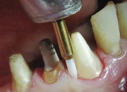 Soft Tissue Trimmer